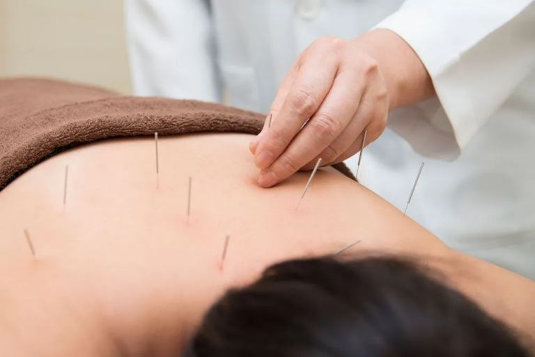 Best TCM Acupuncture: Unlocking the Secrets to Holistic Healing