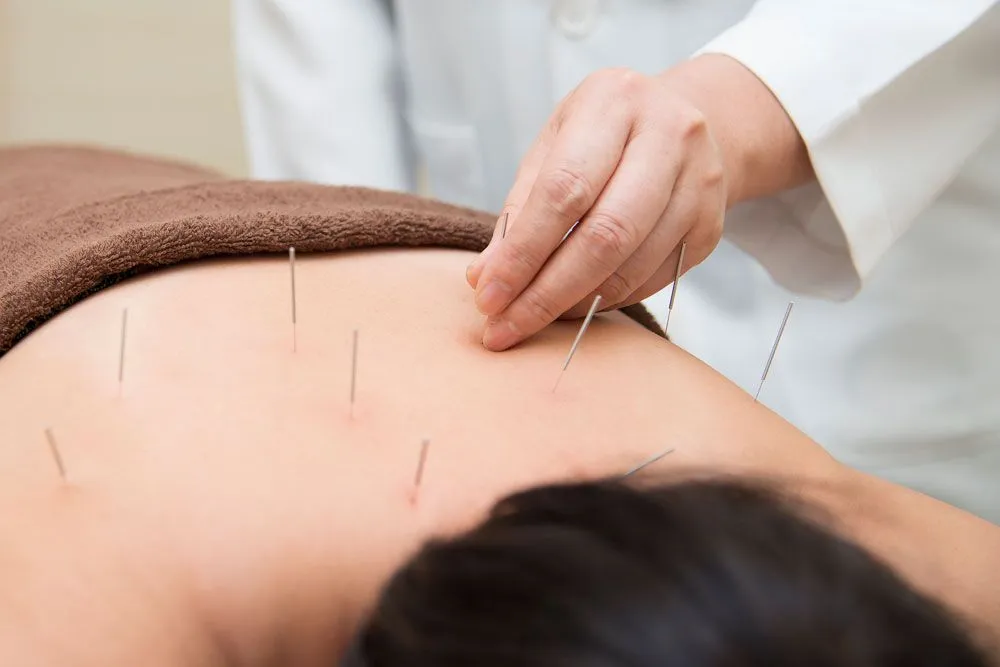 Best TCM Acupuncture